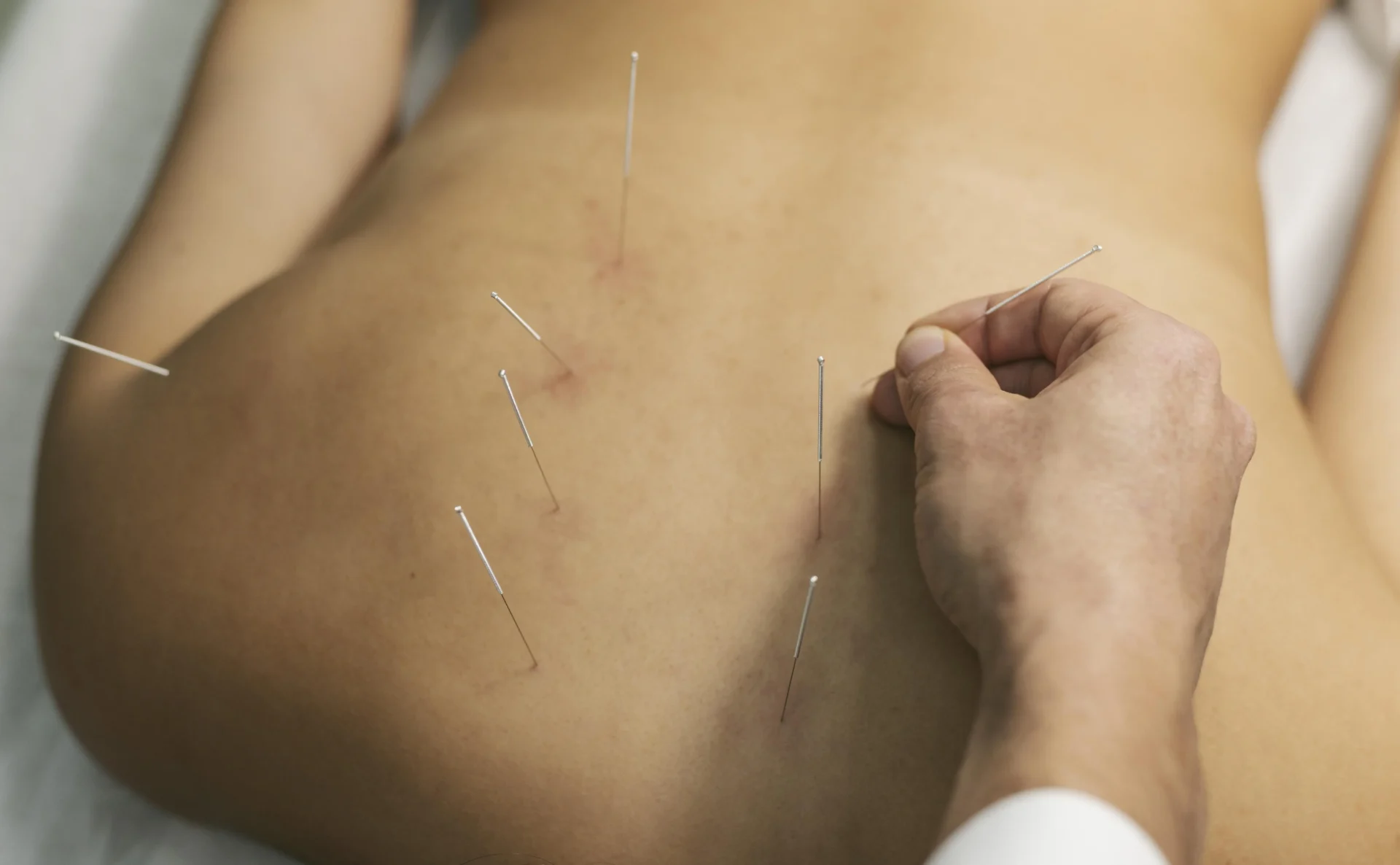 Acupuncture session with multiple needles inserted into a person's back.