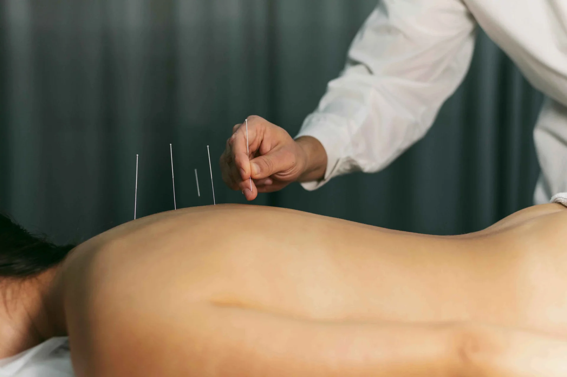 A person receives acupuncture with several needles inserted into their back.