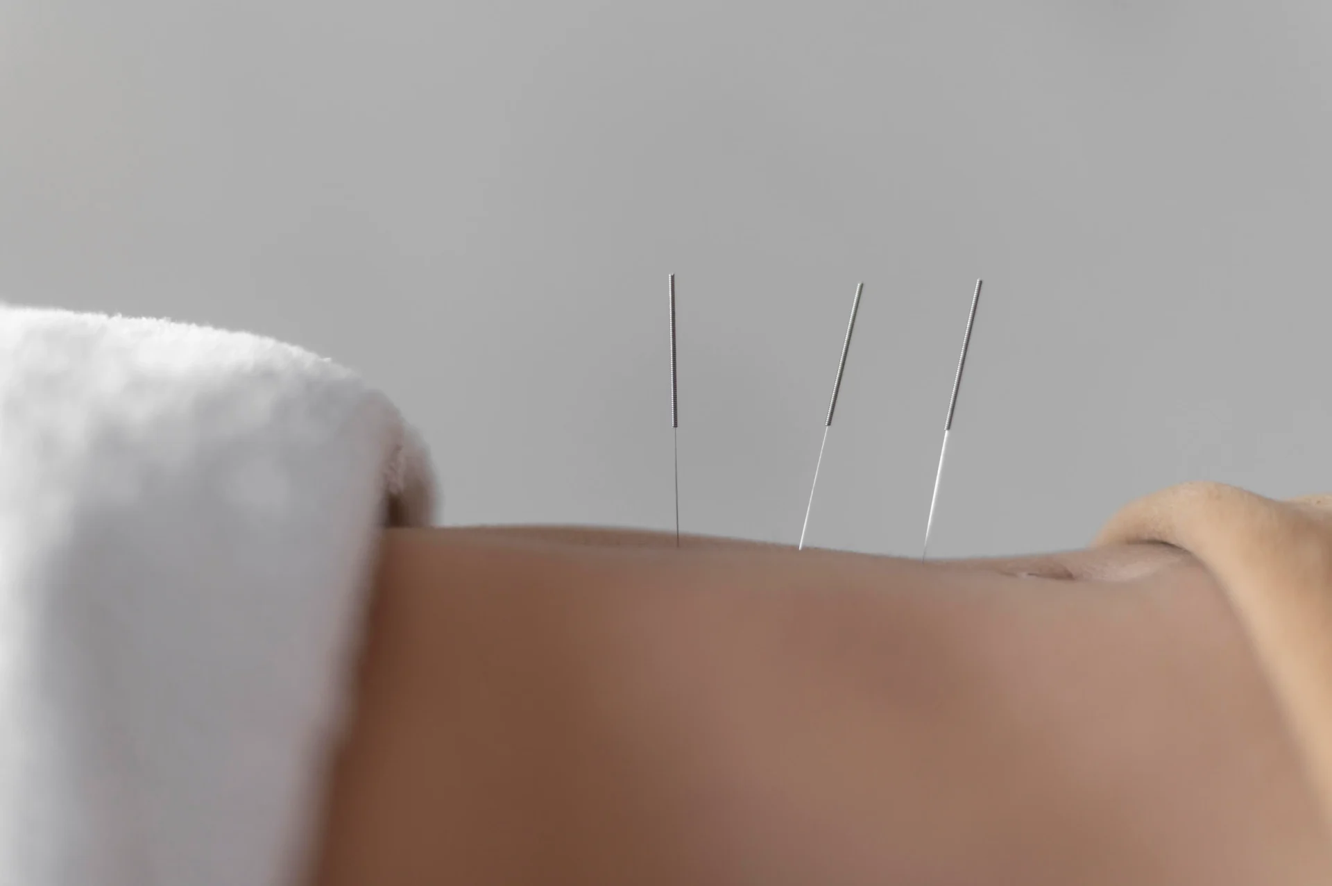 Three acupuncture needles inserted into a person's skin, with a white towel visible in the foreground.